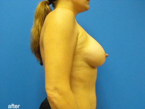 Fat Transfer to Breast Before and After Pictures Phoenix, AZ